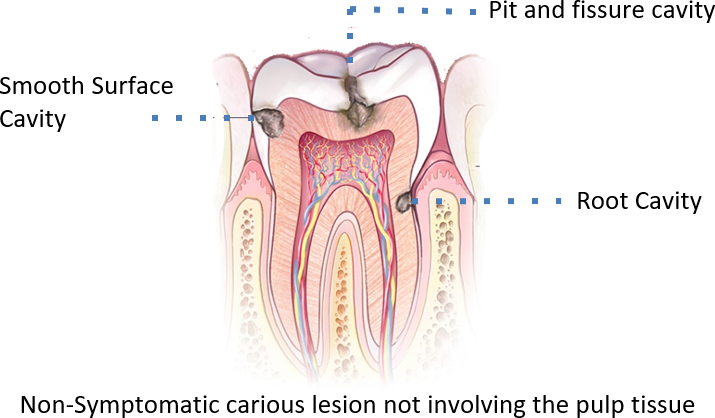 e-SDF 3.25 ml. - Kids-e-Dental